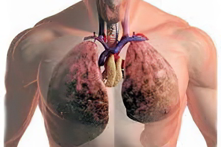 Рак лёгких 4 стадии