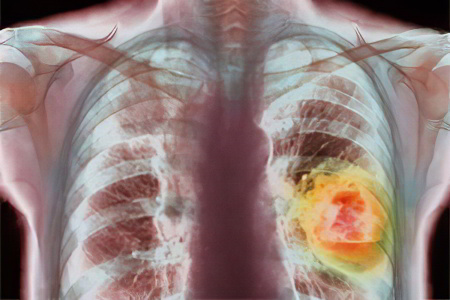Низкодифференцированный рак лёгкого