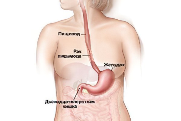 Рак пищевода