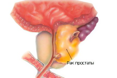 Рак простаты