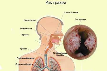 Рак трахеи