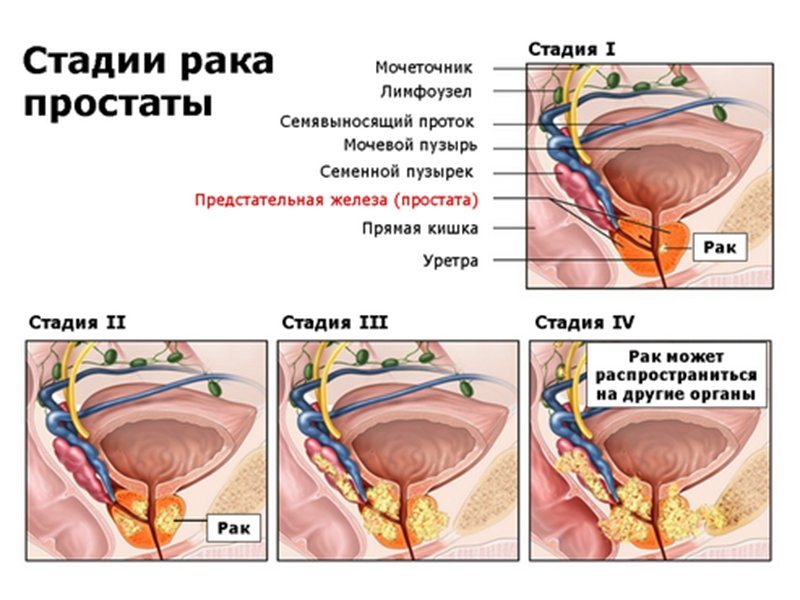 Стадии рака простаты