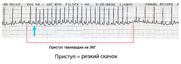 Причины учащённого сердцебиения