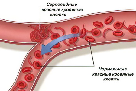Причины развития серповидноклеточной анемии