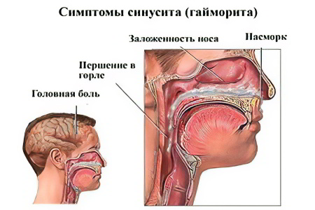 Симптомы острого синусита