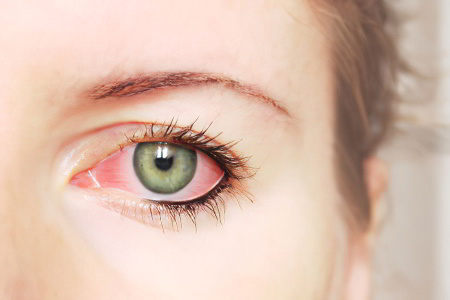 Симптомы розацеа глаз