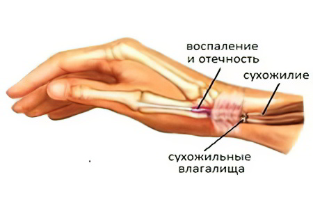 Симптомы крепитирующего тендовагинита