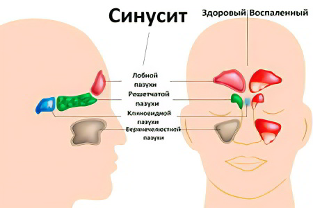 Синусит