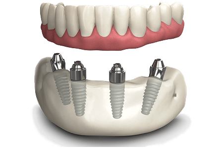 Имплантация All-on-4