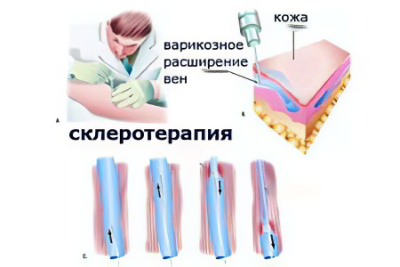 Склеротерапия