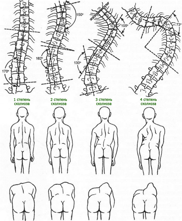 Что такое сколиоз