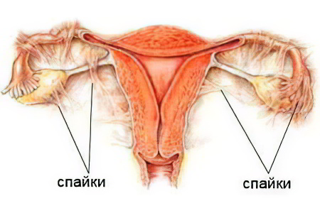 Спайки в малом тазу