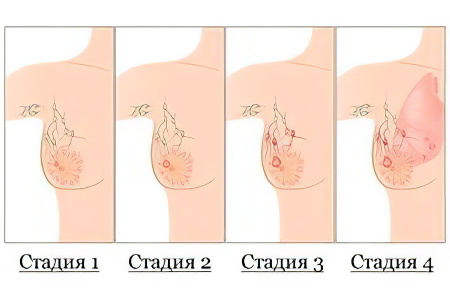 Стадии рака груди