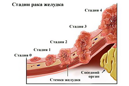 Стадии рака желудка