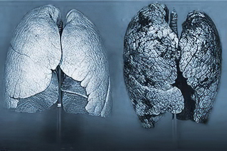 Стадии рака лёгких