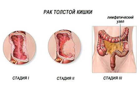 Стадии рака прямой кишки