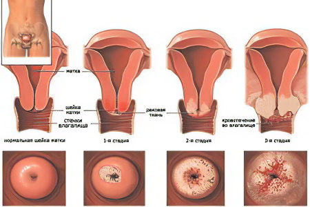 Стадии рака шейки матки