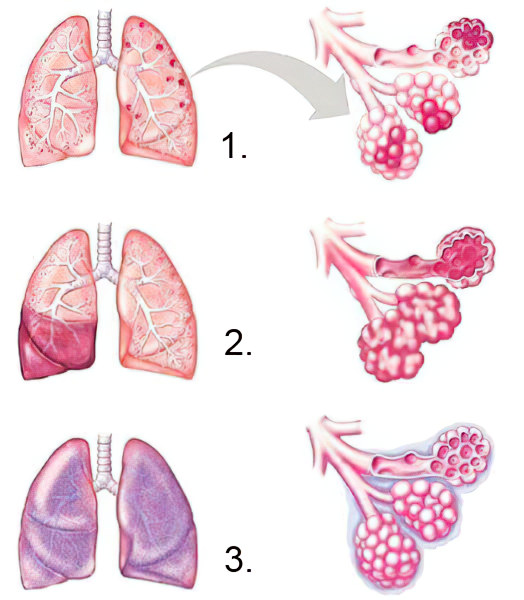 Стадии пневмонии