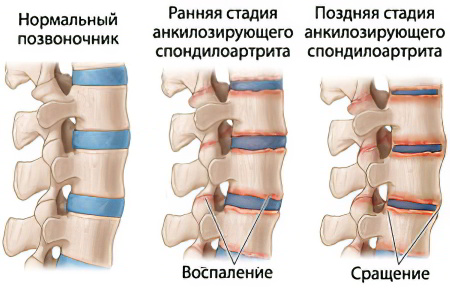 Симптомы ранней стадии