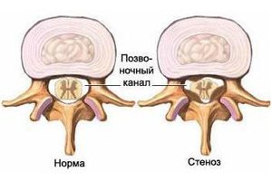 Стеноз позвоночного канала