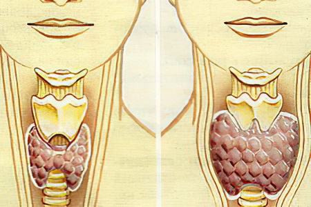 Степени увеличения щитовидной железы