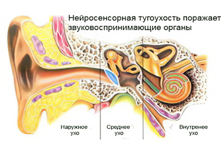 Степени нейросенсорной тугоухости