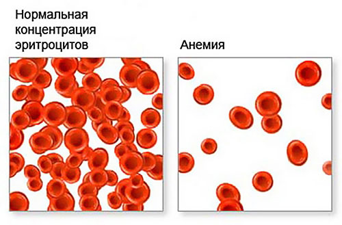 Анемия – что это такое