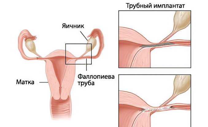 Перевязка маточных труб