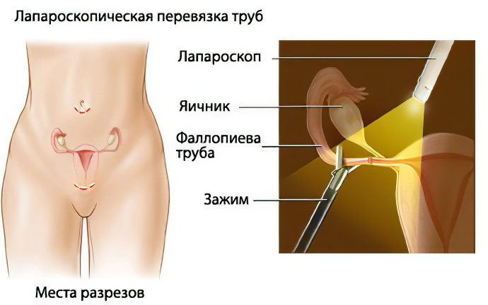 Перевязка маточных труб