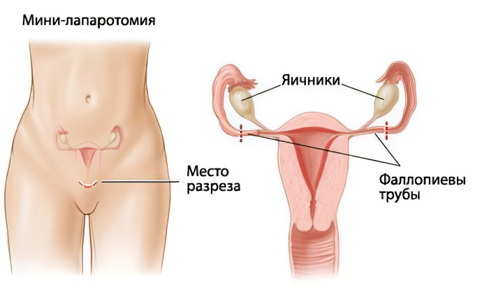 Перевязка маточных труб