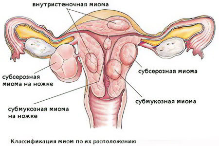 Субмукозная миома матки Субмукозная миома матки