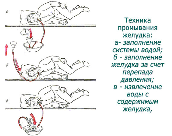 техника промывания желудка