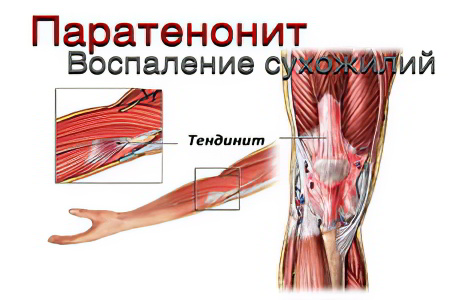 паратенонит