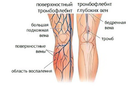 Тромбофлебит