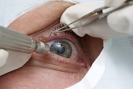 Лечение сетчатки глаза