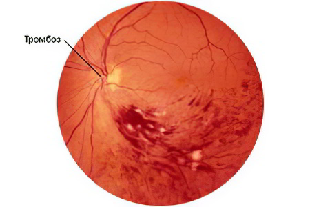 тромбоз сетчатки глаза