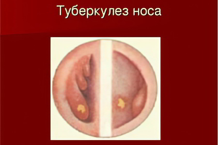 Туберкулез носа