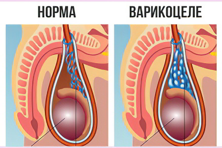 Варикоцеле