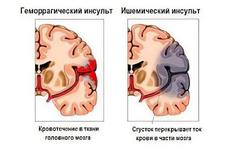 Виды ишемического инсульта