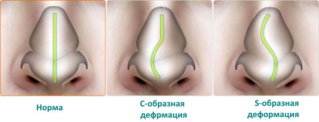 Виды искривления носовой перегородки
