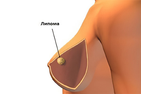 Виды липом молочной железы