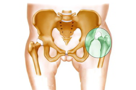 Боль в тазобедренном суставе – причины. Болит тазобедренный сустав – что делать, как лечить?