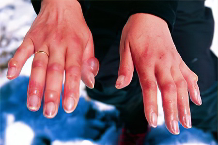 Причины появления водянки рук