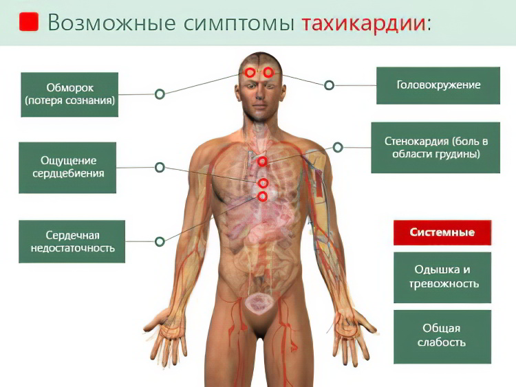 Симптомы пароксизмальной тахикардии