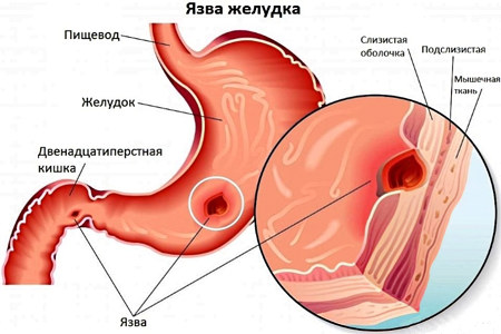 Язва желудка