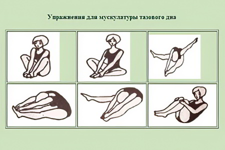 Опущение матки: можно ли остановить?