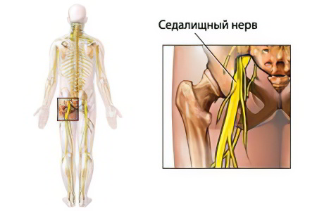 защемления седалищного нерва