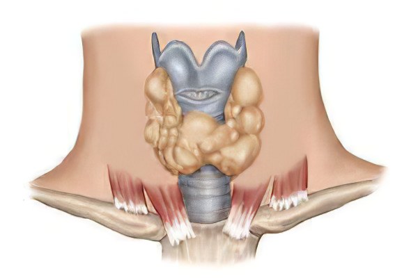 Диффузно-узловой зоб