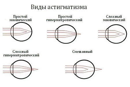Разновидности астигматизма