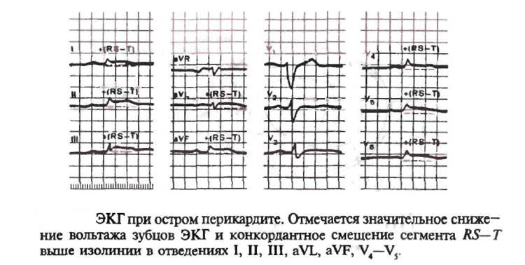 Диагностика перикардита